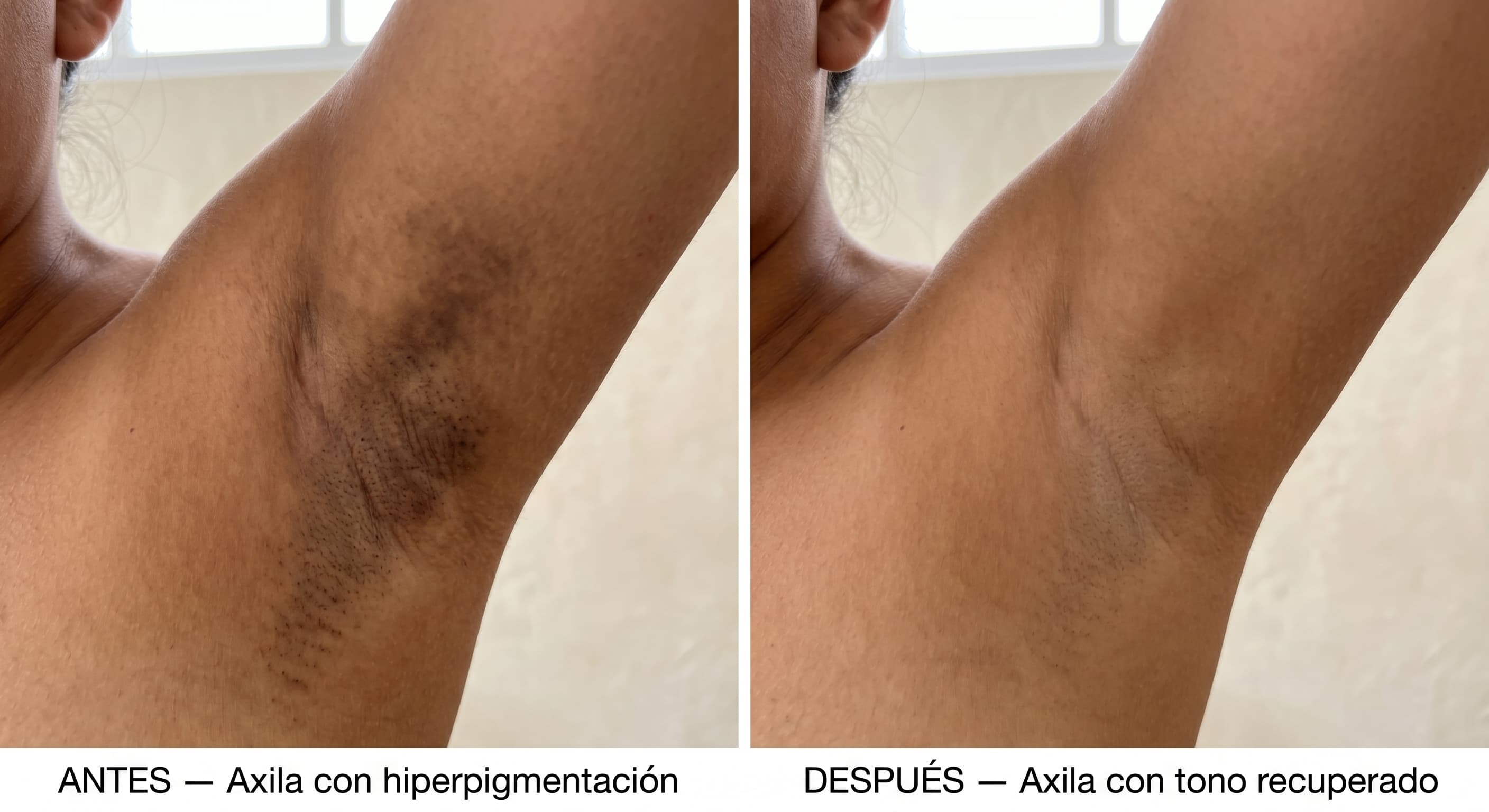 Antes y después — Axilas
