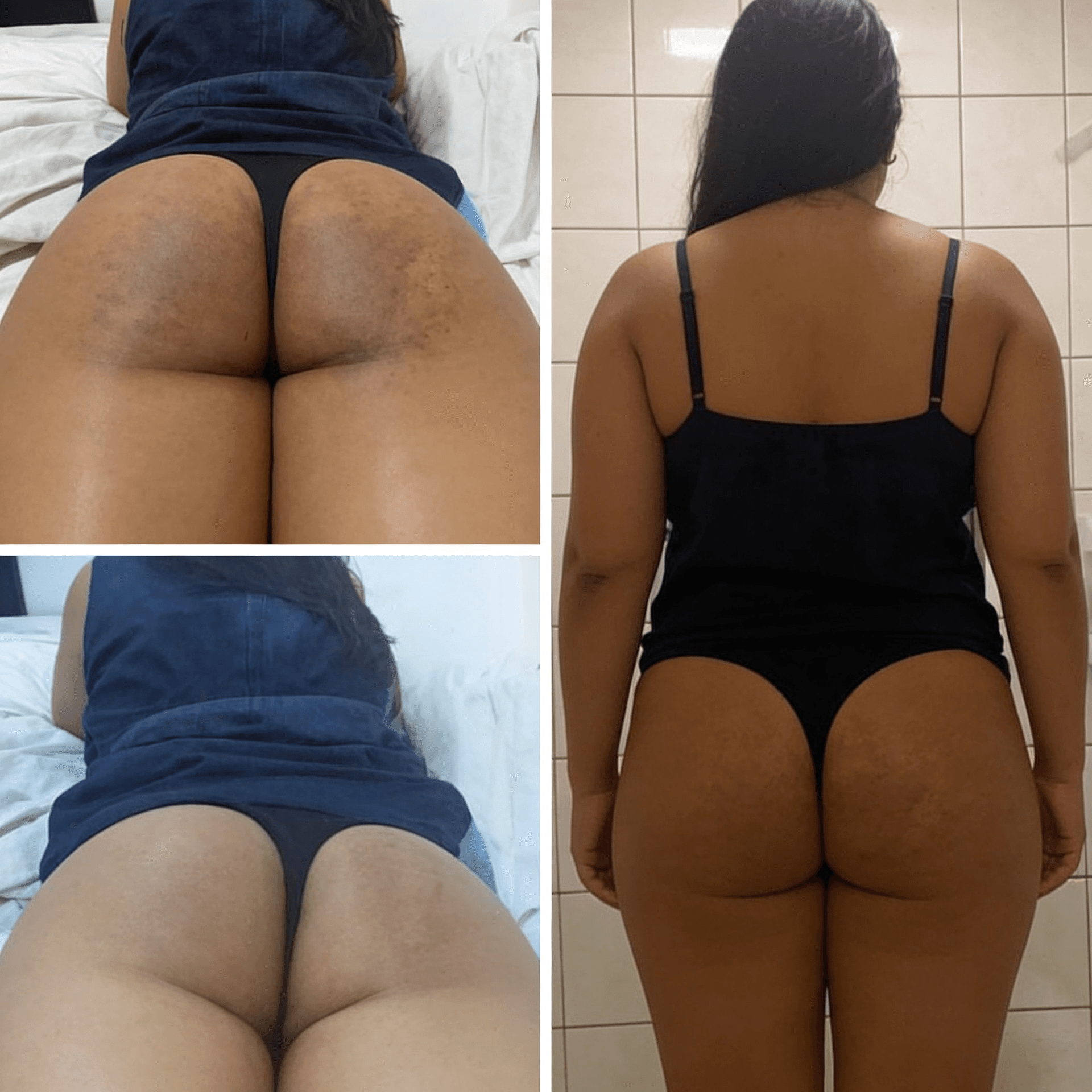 Antes y después — Glúteos
